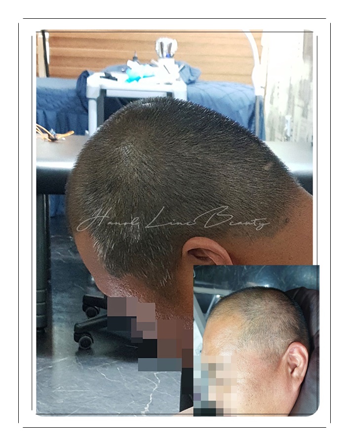 의정부두피문신