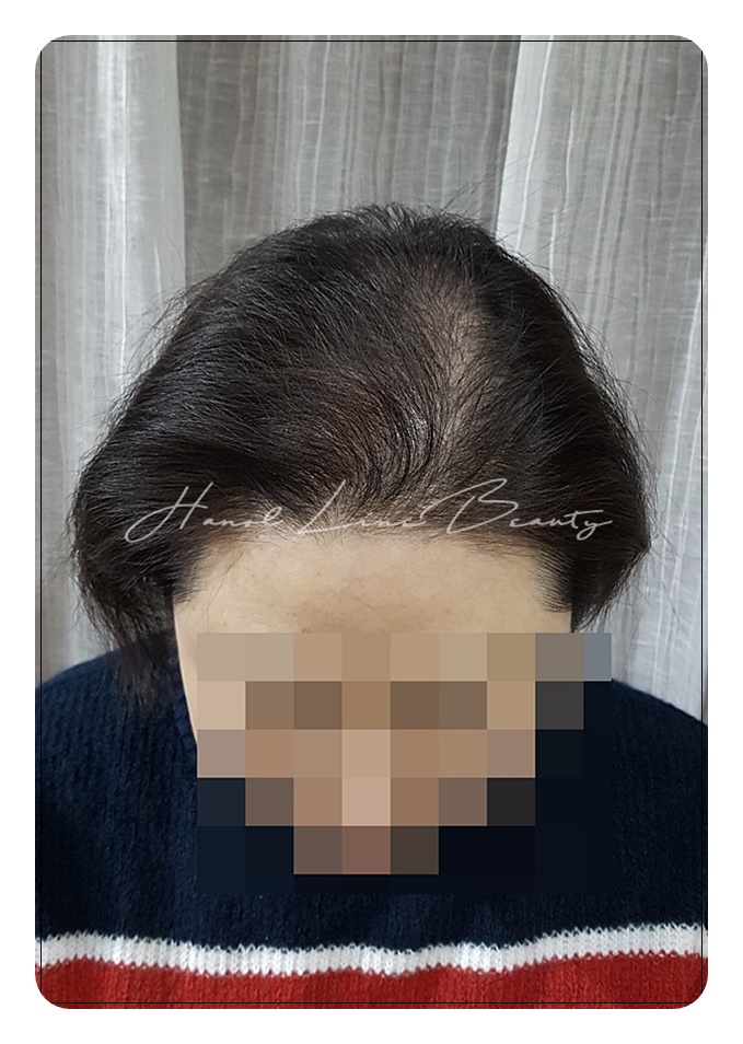 김포smp두피문신