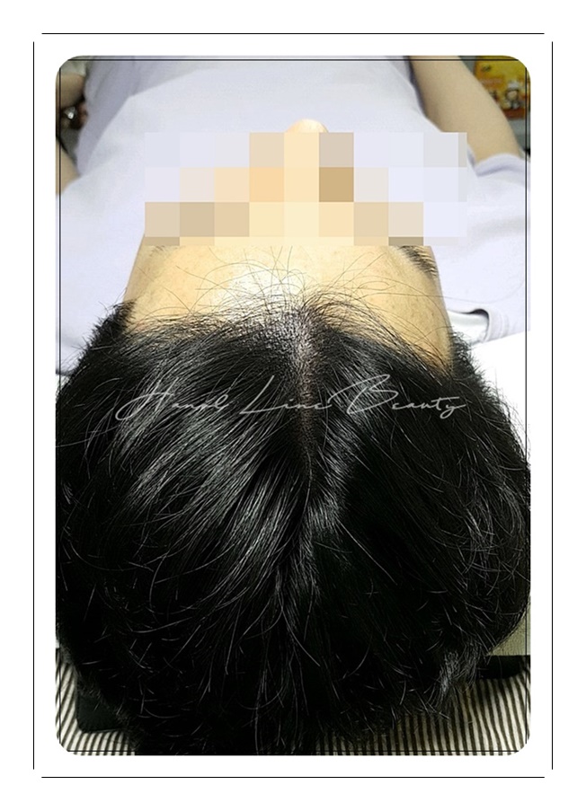 목동smp두피문신