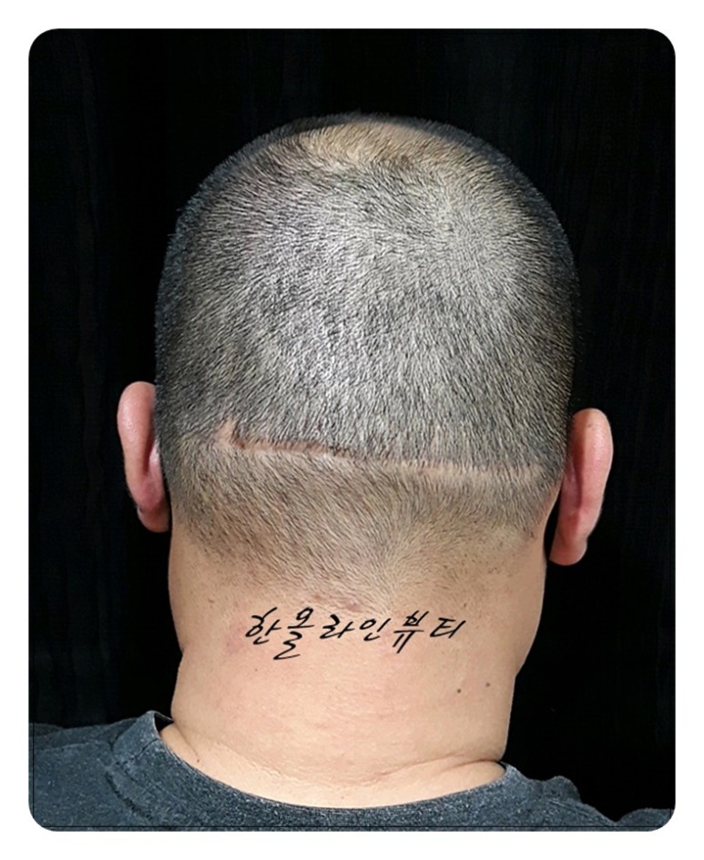 smp두피문신