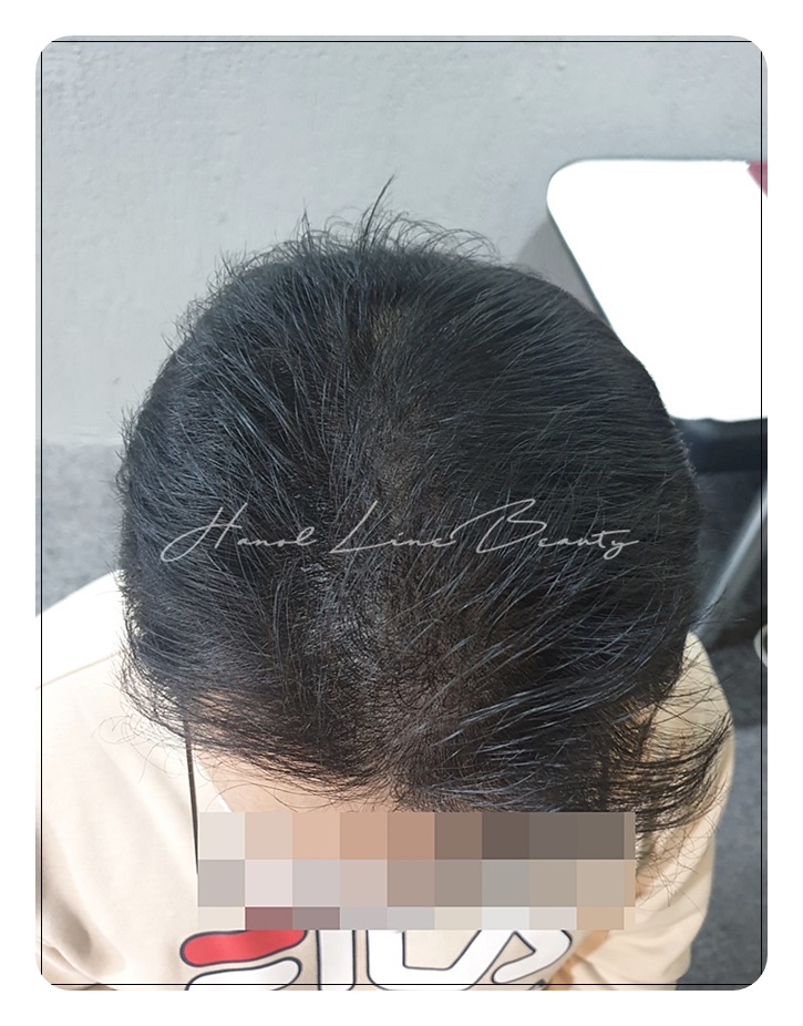 smp두피문신