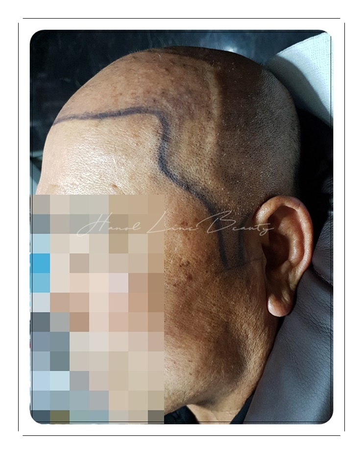 대머리문신