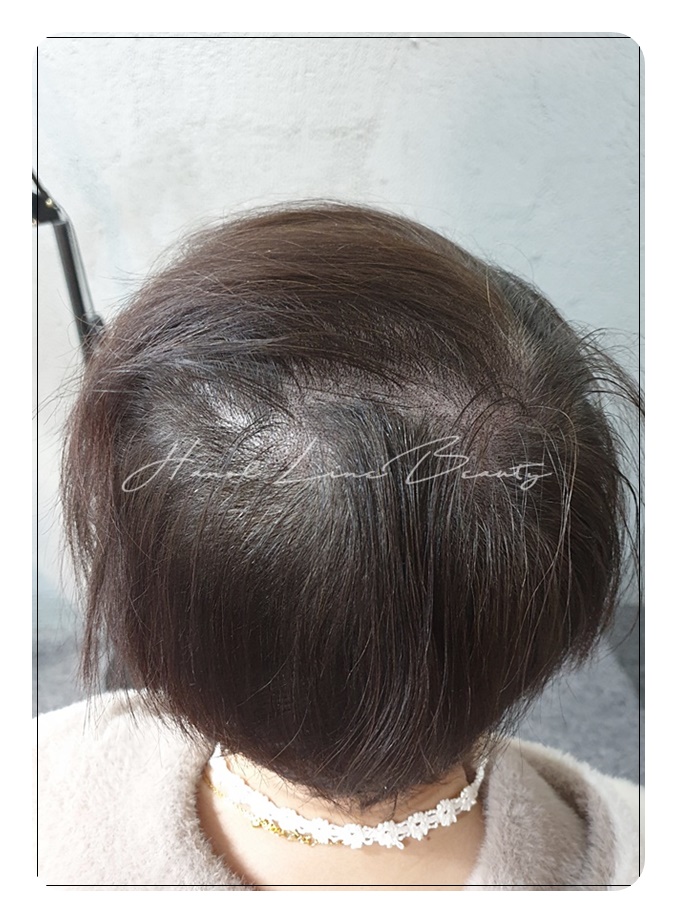 의정부smp두피문신