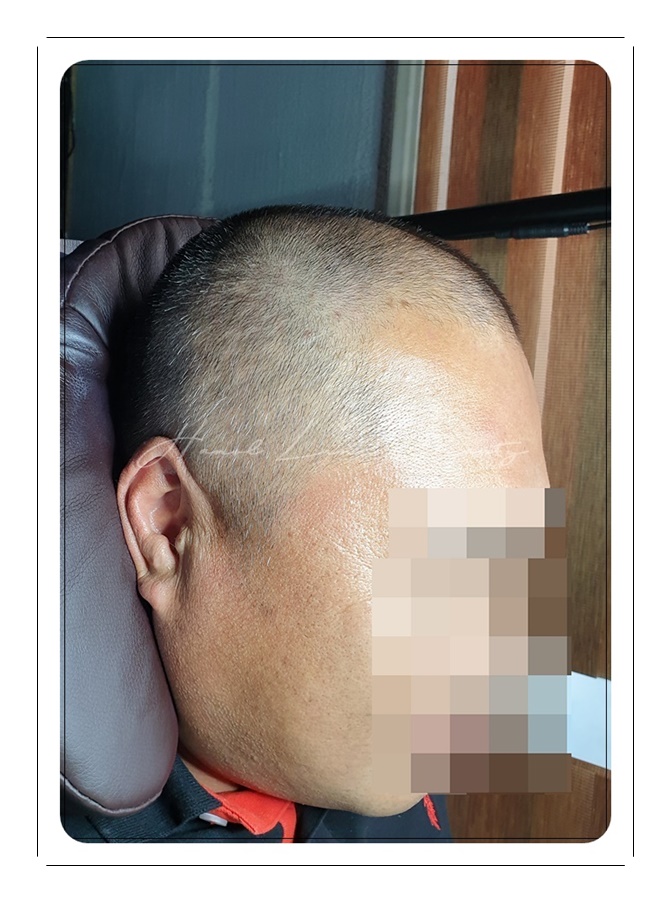 김포두피문신