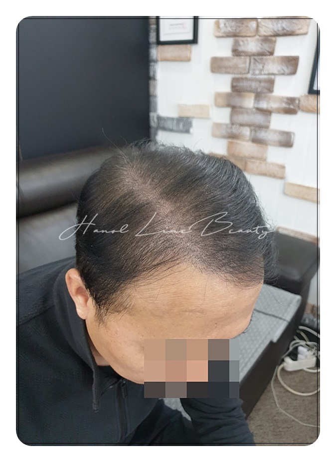 김포두피문신