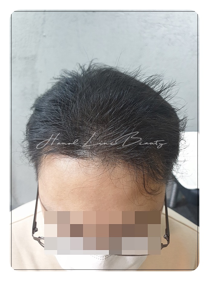 남성두피문신