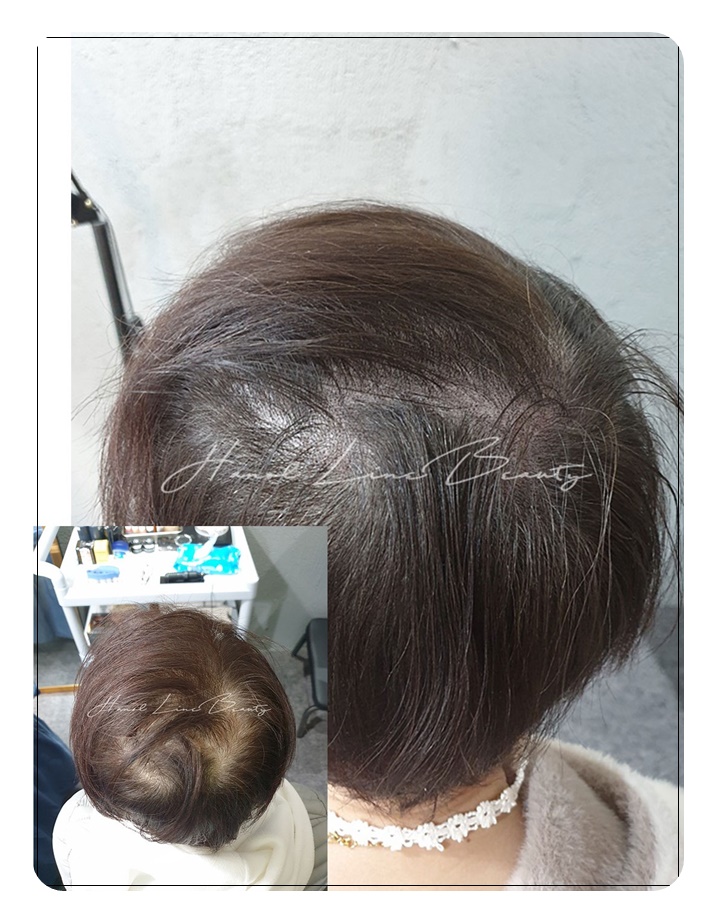 탈모커버