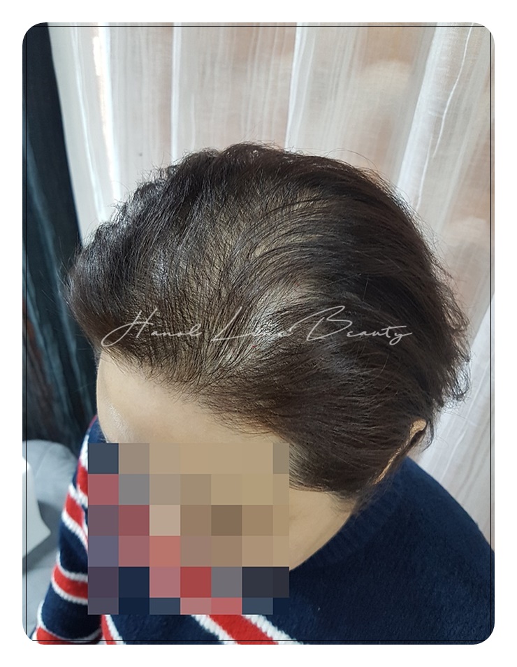 구래동두피문신