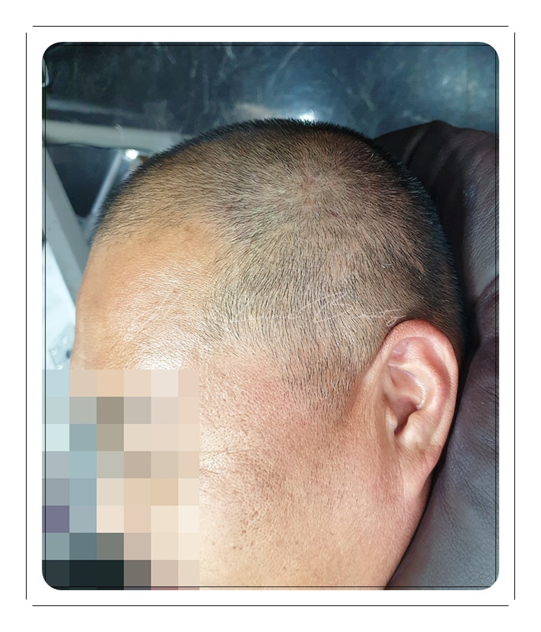 일산두피문신