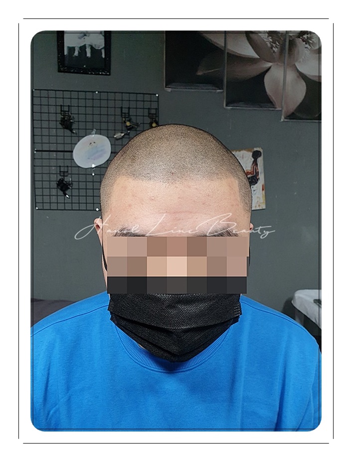 김포smp두피문신
