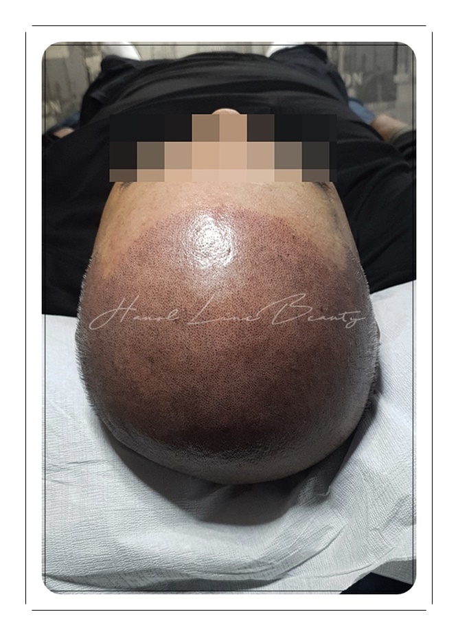 의정부두피문신