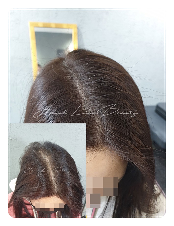 두피밀도보강