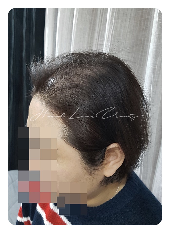 양촌두피문신
