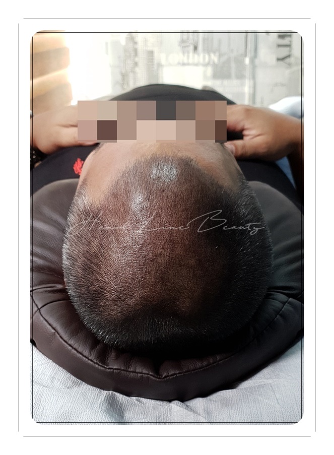 파주두피문신