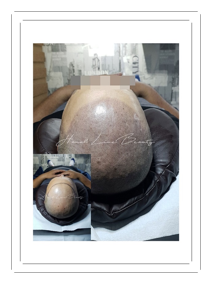 인천smp두피문신