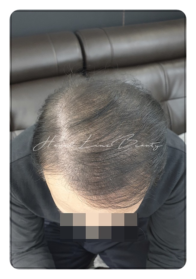 장기동두피타투