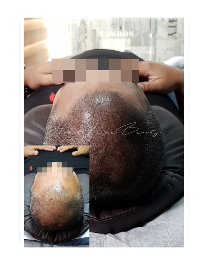 인천smp두피문신