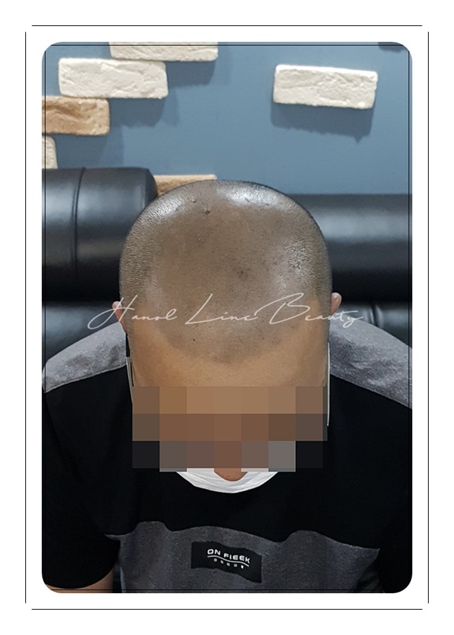 두피밀도보강