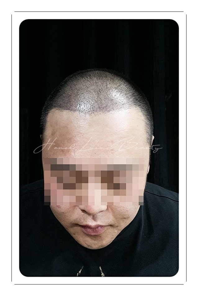남성두피문신