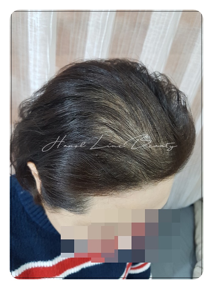 정수리두피문신