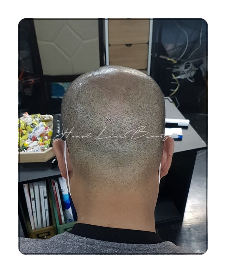 탈모커버