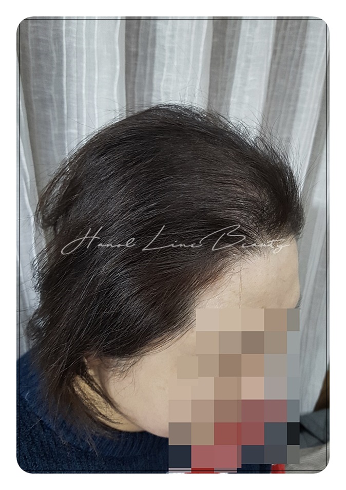 검단두피문신