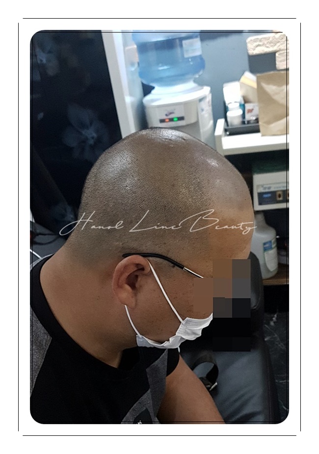 민머리밀도보강