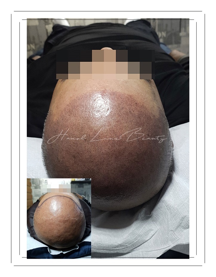 민락동두피문신