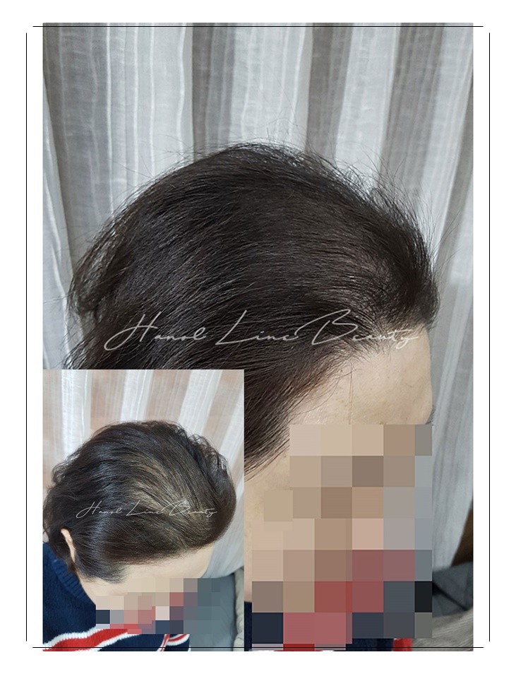 양곡두피문신