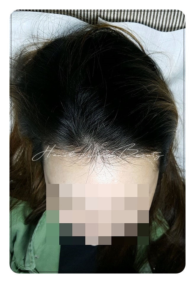 일산두피문신