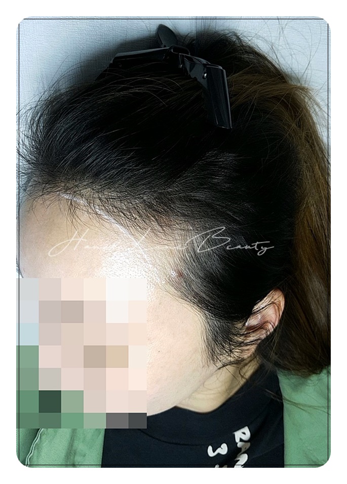 여성헤어라인