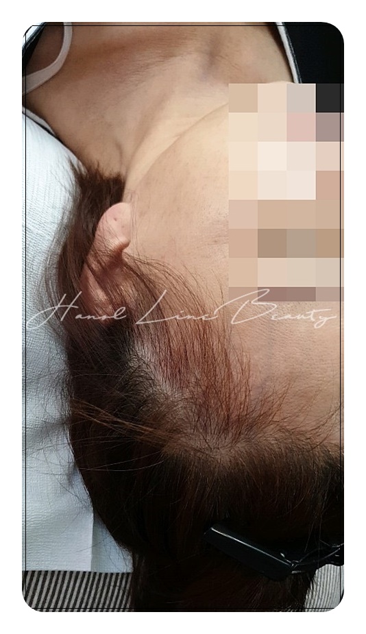 파주smp두피문신