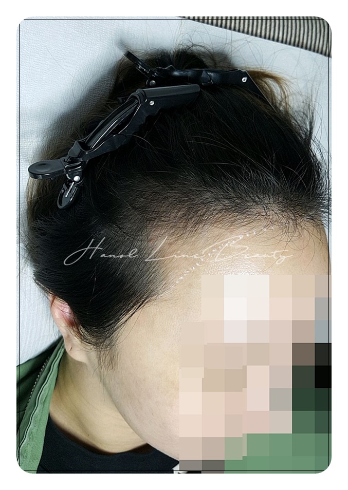 일산smp두피문신