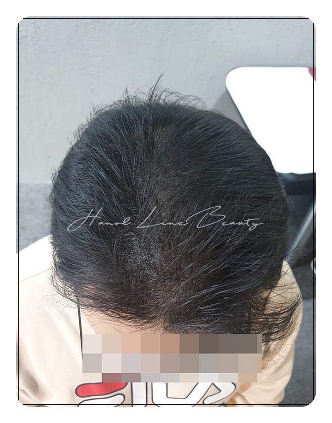 남성두피문신