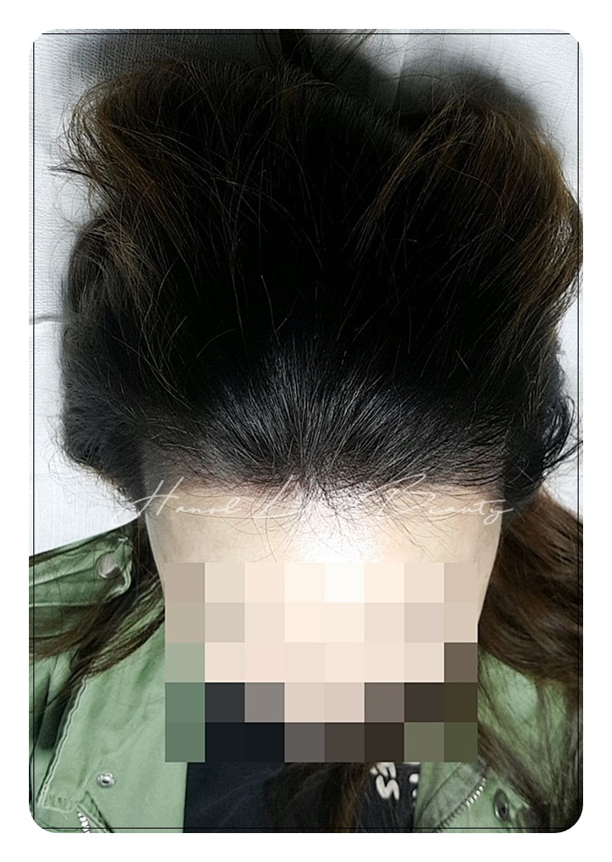 여성탈모밀도보강
