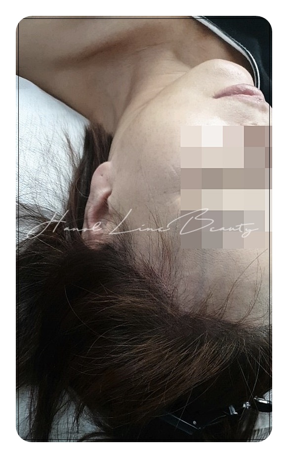 안면거상후