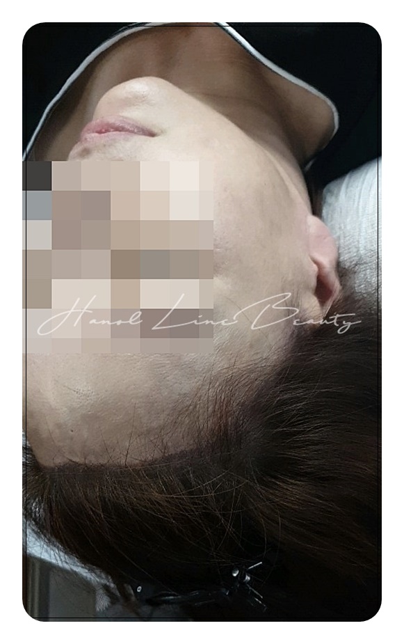 밀도보강