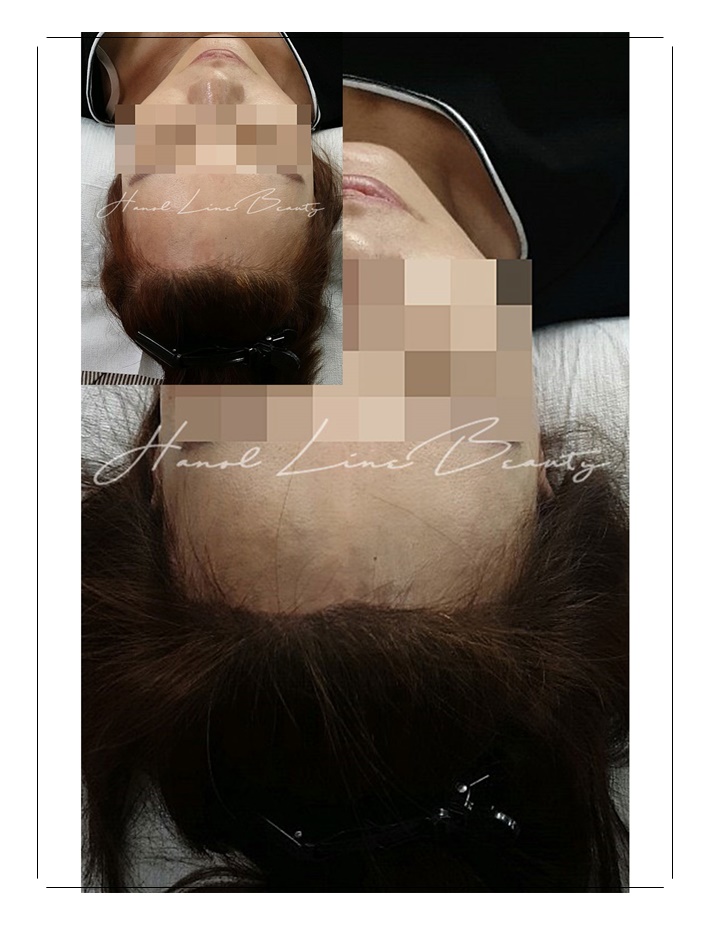 야당동두피문신
