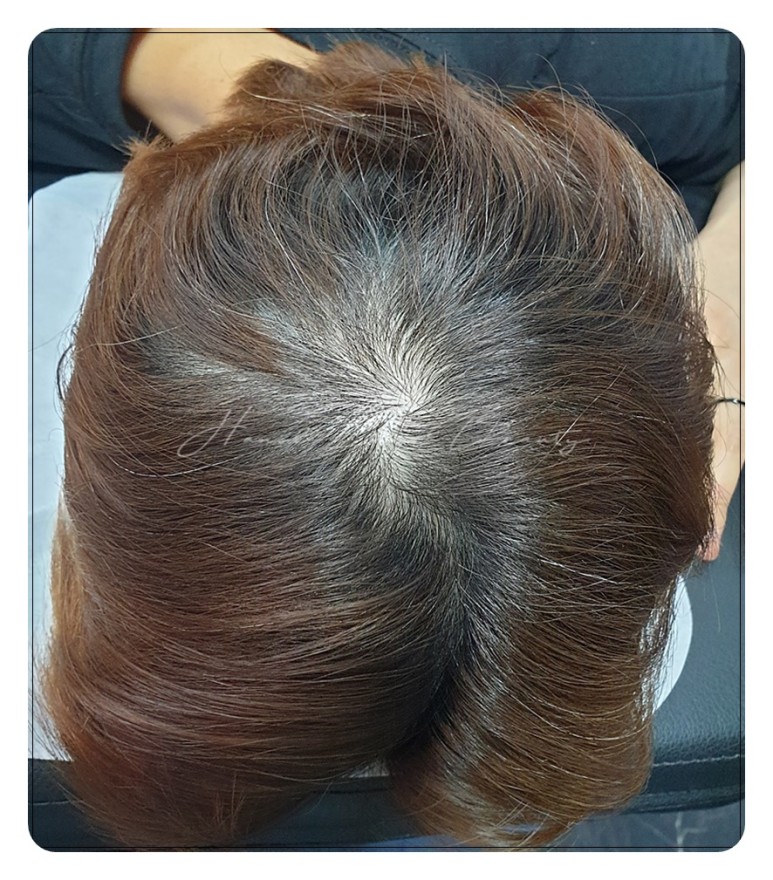 김포두피문신