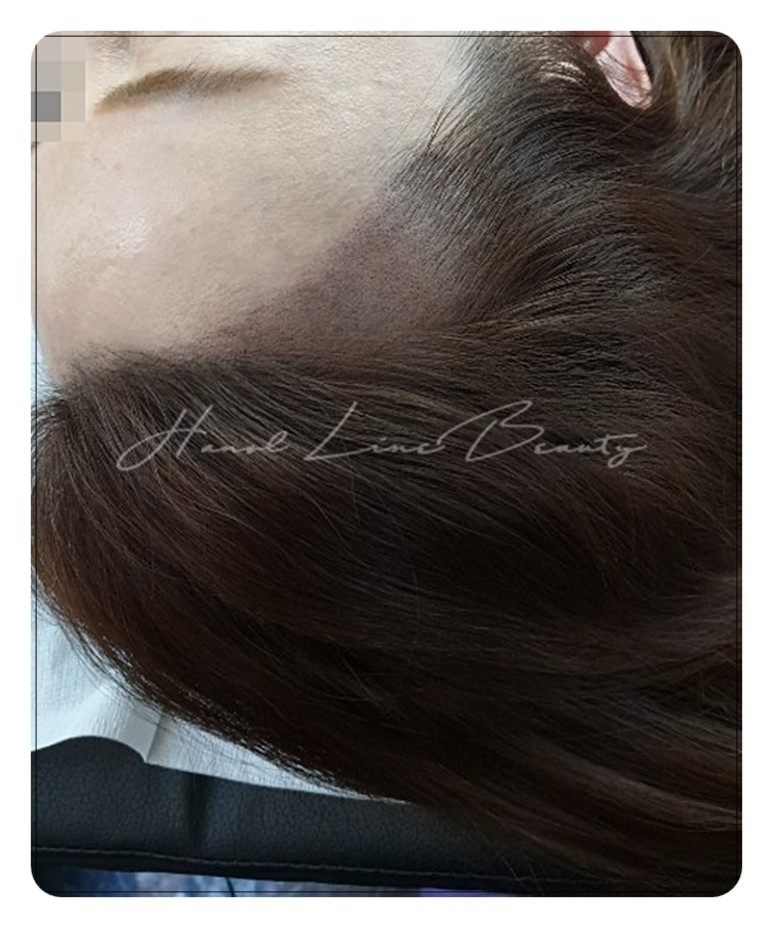 헤어라인
