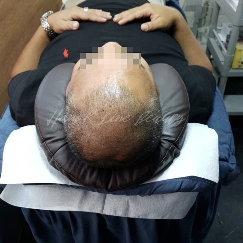 일산두피문신