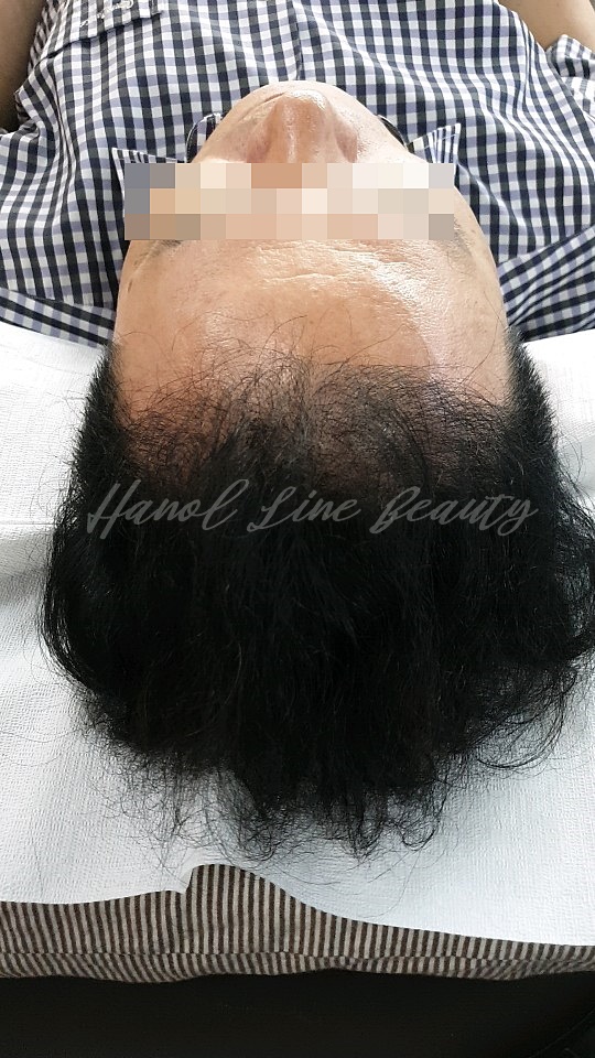 일산두피문신