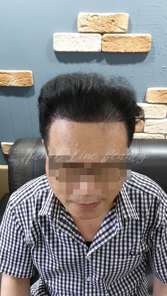 여성두피문신