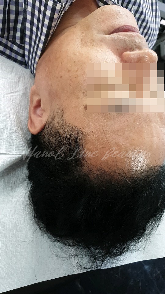 일산smp두피문신