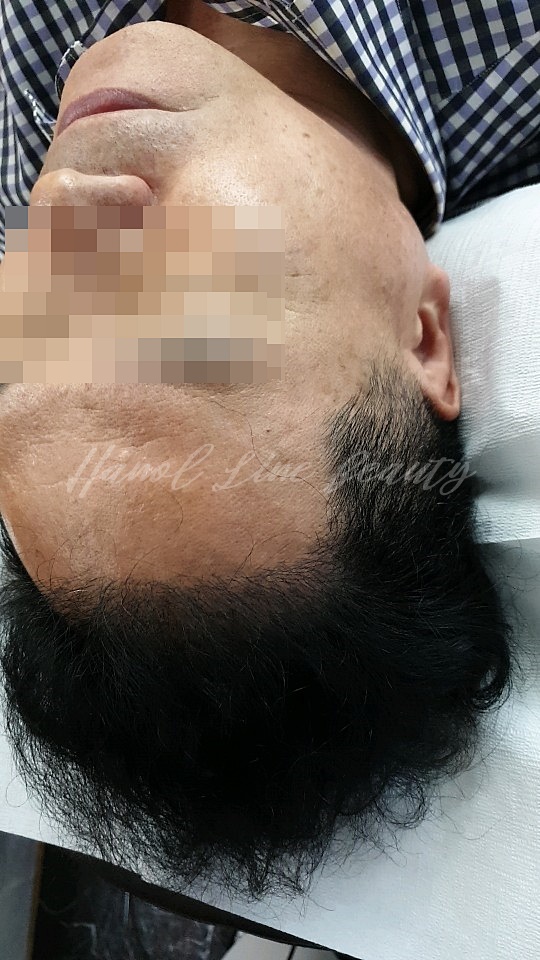 일산두피타투