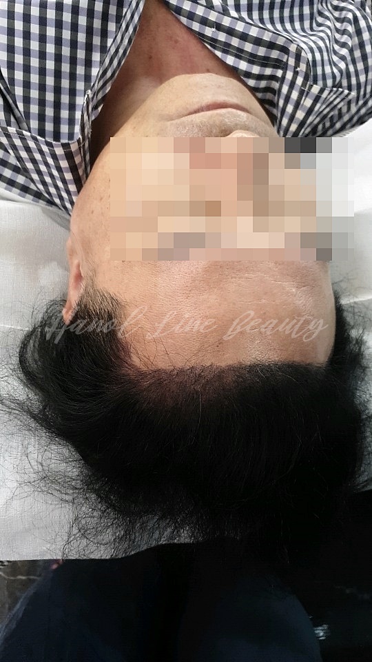 정수리두피문신