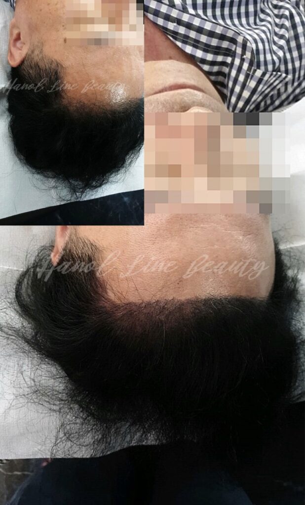 smp두피문신