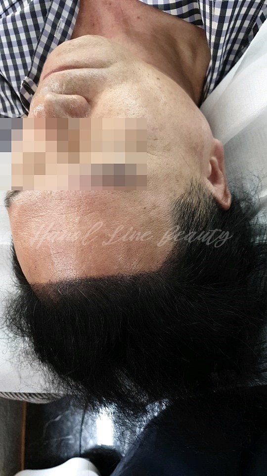 탈모커버