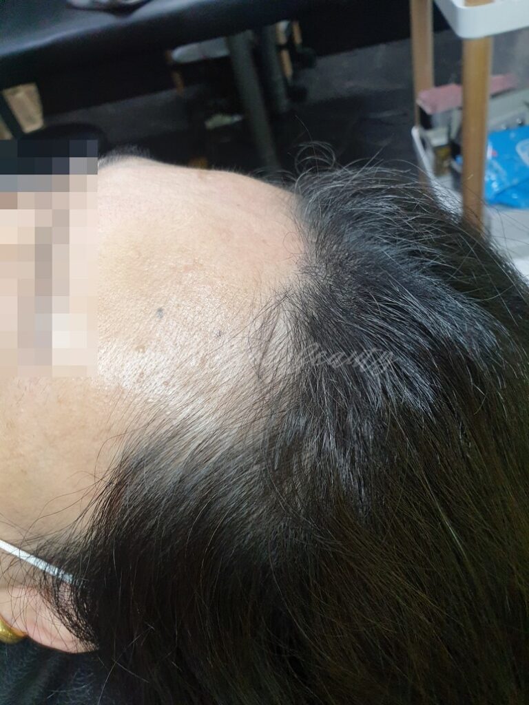 일산두피문신