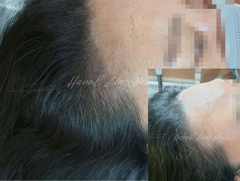 정발산두피문신
